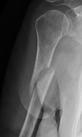 Humerus nonunion plate