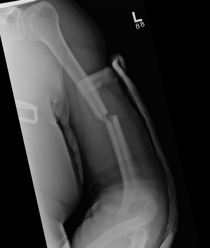 Humerus shaft 1