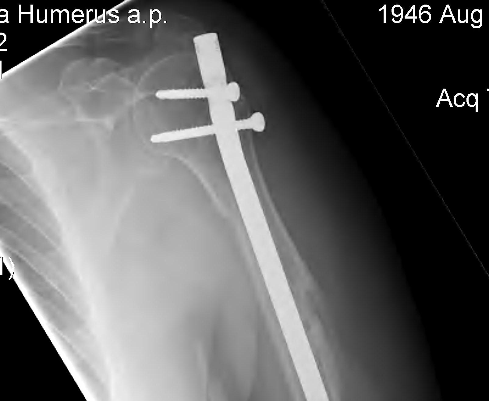 Humerus Prominent IM Nail