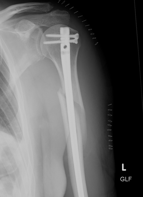 Humeral Nail AP