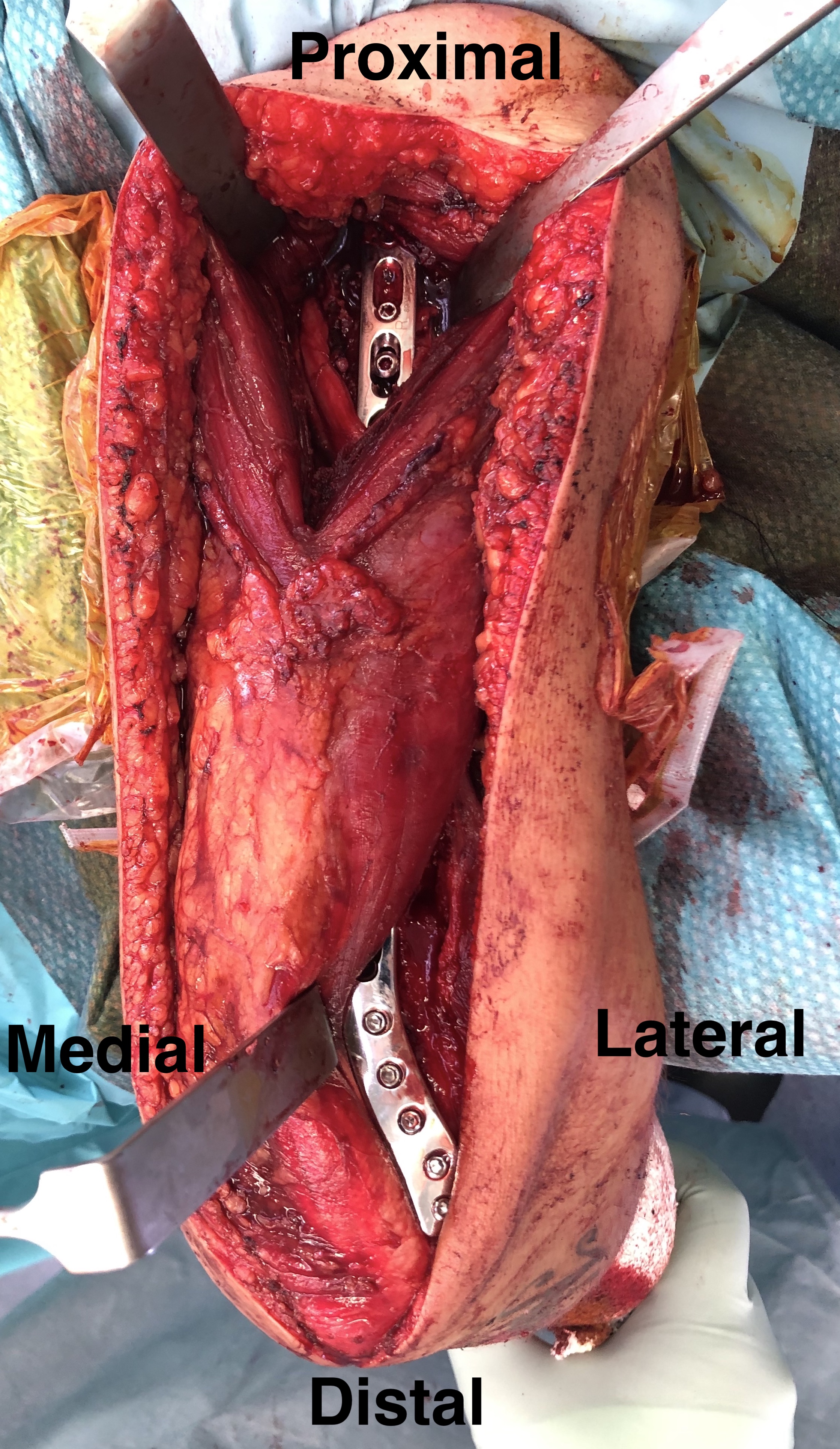 Distal humerus 2