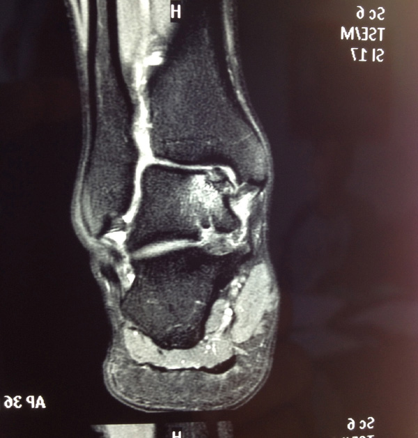 medial-td-lesions