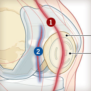 5W Samples - Knee Replacement