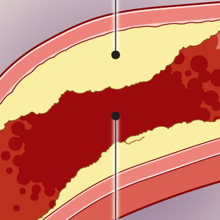 5W Samples - Stroke