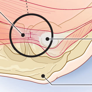 5W Samples - Tennis Elbow