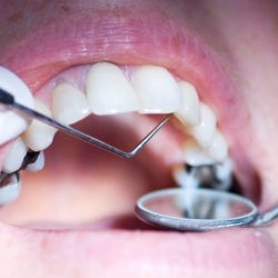 How Dangerous are Mercury (Silver) Fillings?