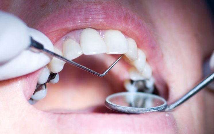 How Dangerous are Mercury (Silver) Fillings?