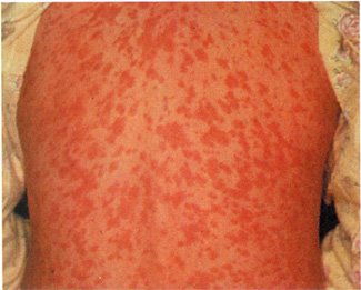 Petechiae Causes In Pregnancy