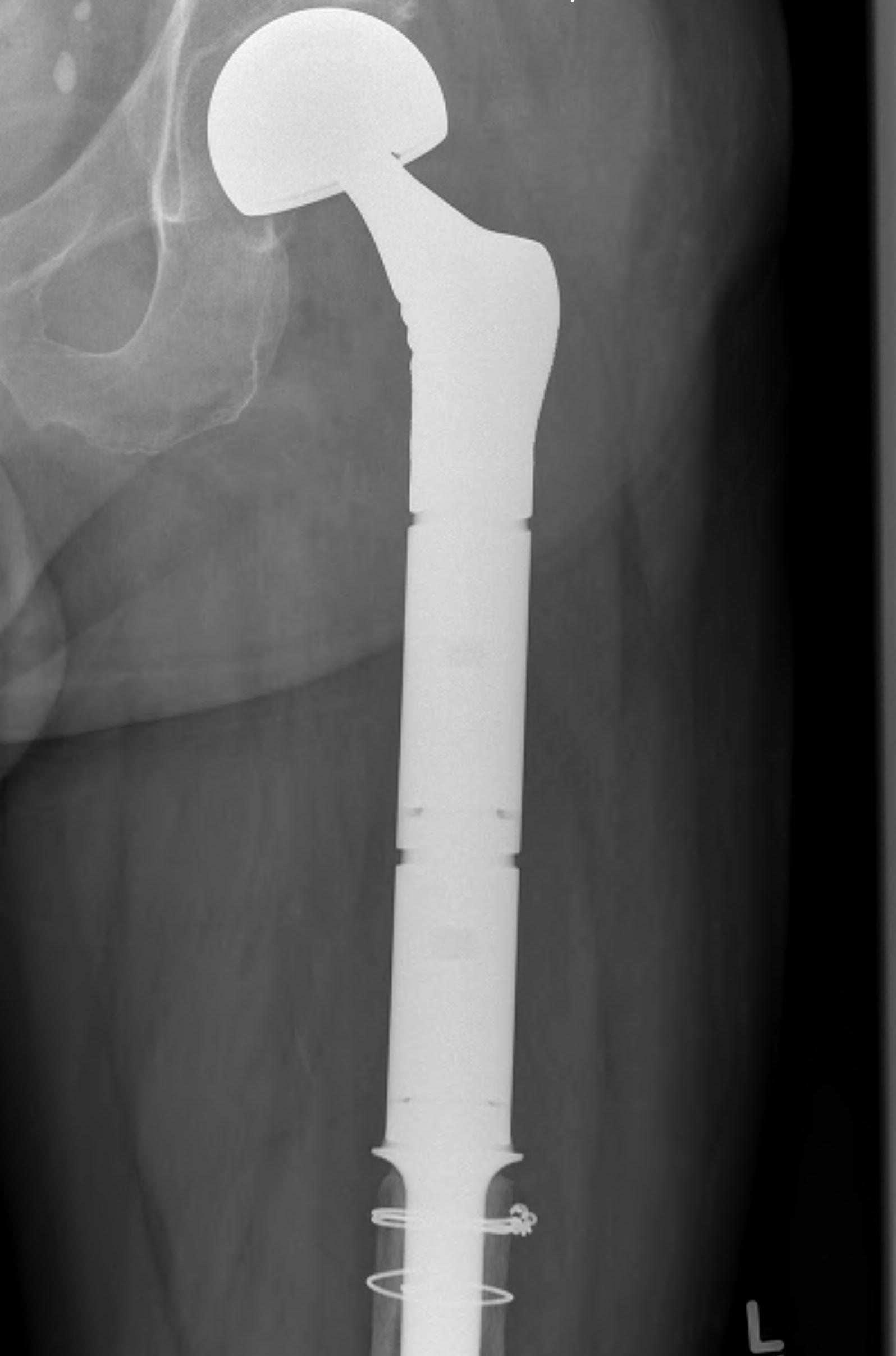 Proximal Femoral Replacement