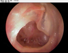 Infected Tympanic Membrane Image