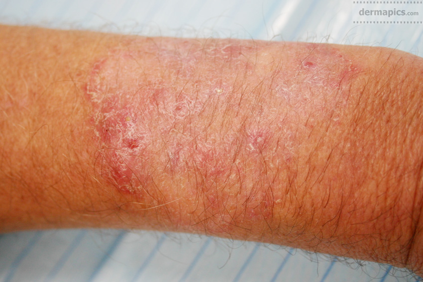 fungal infection of
                        the skin of the arm