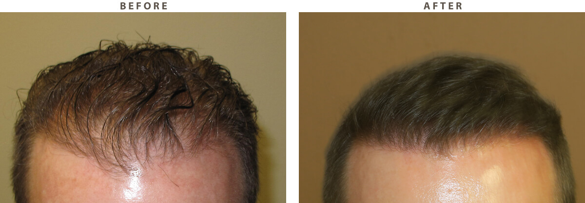 Hair Transplant - Before and After Pictures