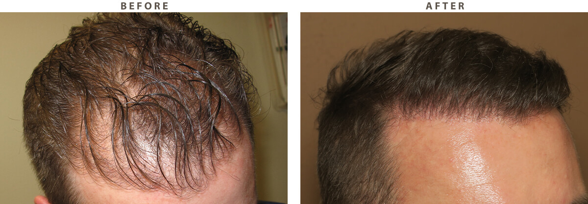 Hair Transplant - Before and After Pictures