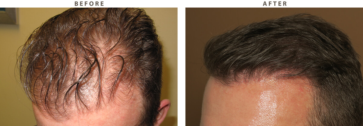 Hair Transplant - Before and After Pictures