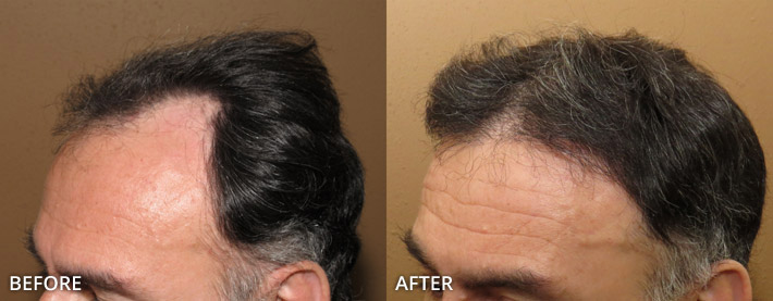 FUE Hair Transplantation – Before and After Pictures