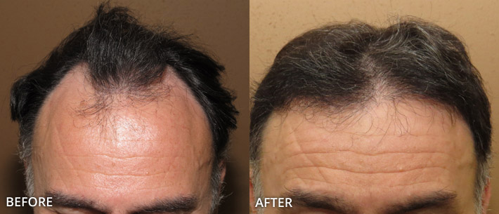 FUE Hair Transplantation – Before and After Pictures