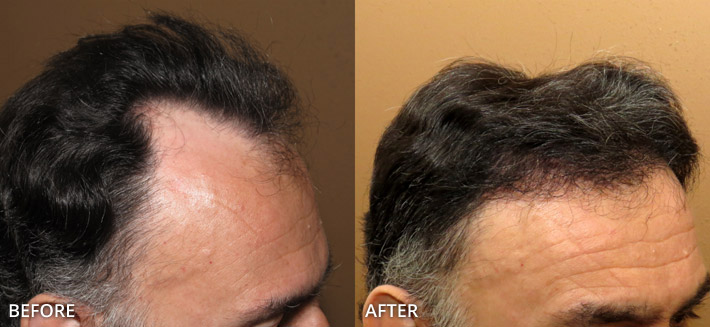 FUE Hair Transplantation – Before and After Pictures