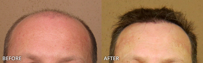 FUE Hair Transplantation – Before and After Pictures