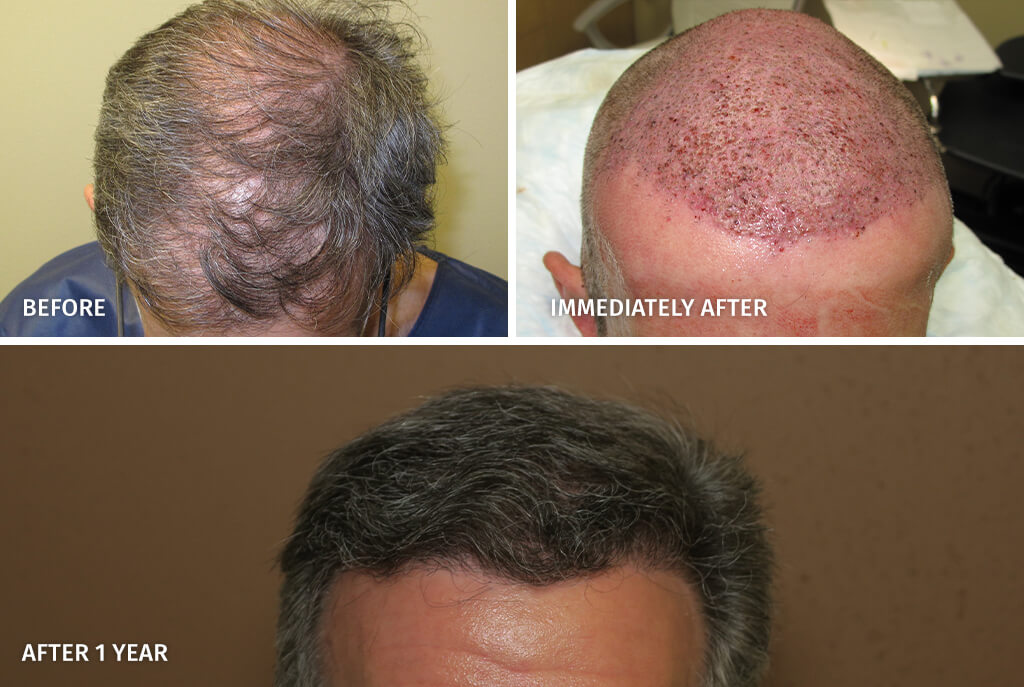 Hair Transplant - Before and After Pictures