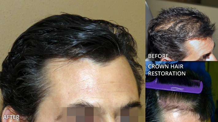 FUE Hair Transplantation – Before and After Pictures