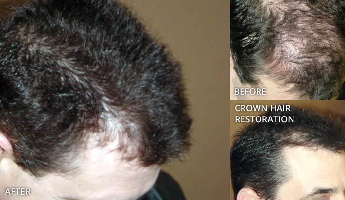 FUE Hair Transplantation – Before and After Pictures