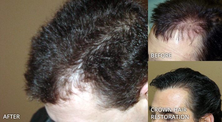 FUE Hair Transplantation – Before and After Pictures