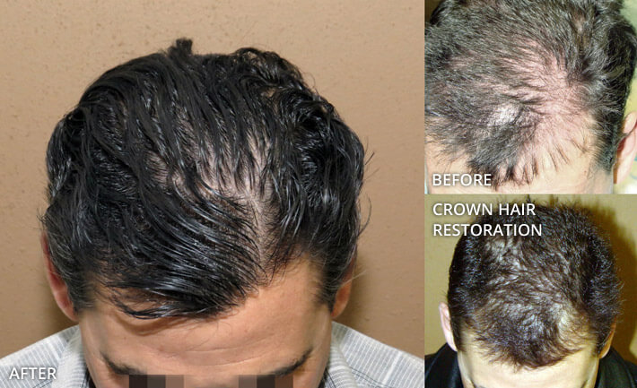 FUE Hair Transplantation – Before and After Pictures