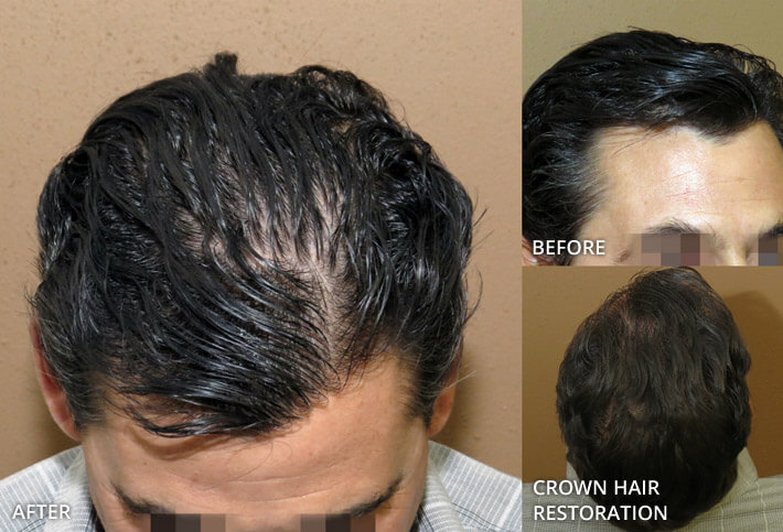 FUE Hair Transplantation – Before and After Pictures