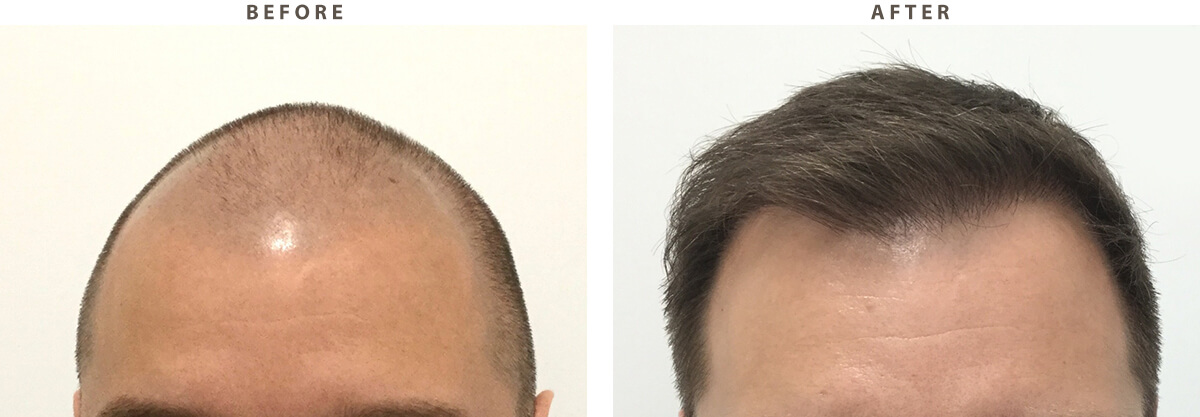 Artas Hair Transplant - Before and After Pictures