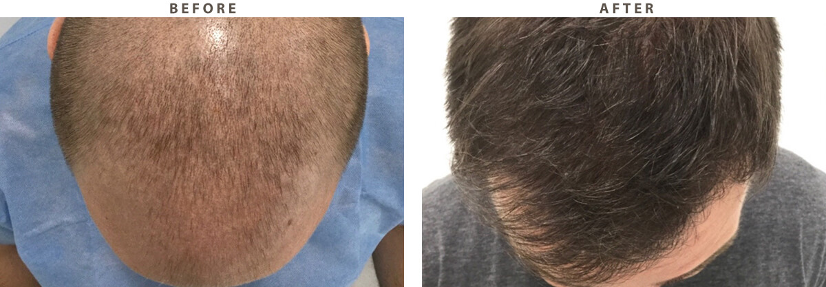 Artas Hair Transplant - Before and After Pictures