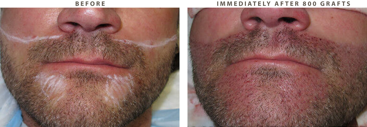 Artas Hair Transplant - Before and After Pictures