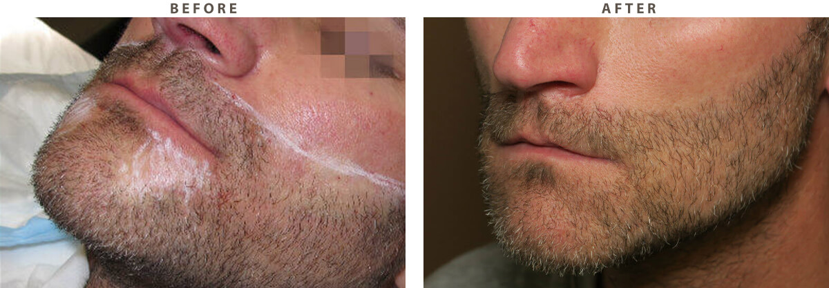 Artas Hair Transplant - Before and After Pictures