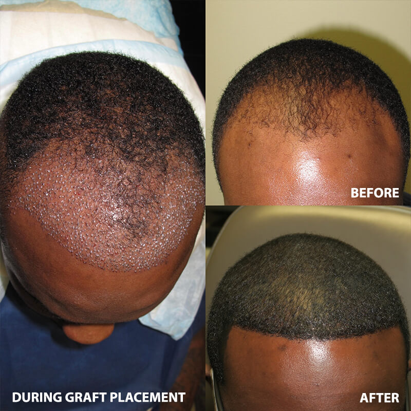 ARTAS Hair Restoration - Before and After Pictures