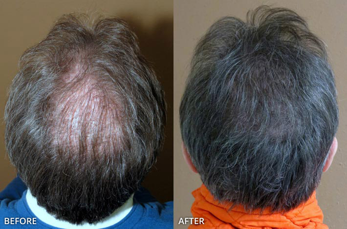 FUE Hair Transplantation – Before and After Pictures