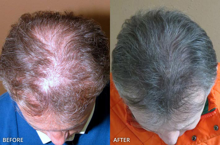 FUE Hair Transplantation – Before and After Pictures