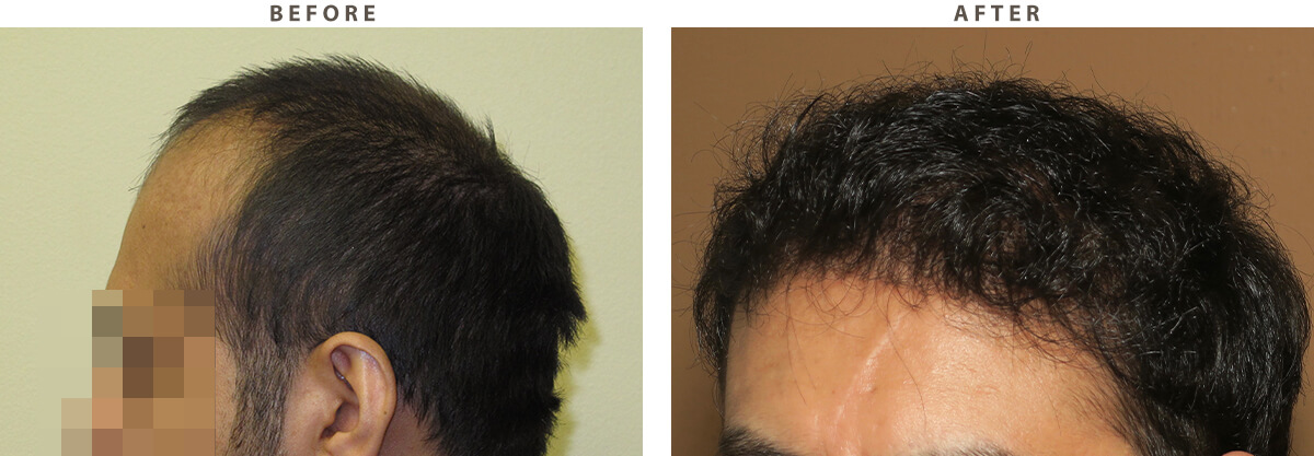 ARTAS - Before and After Pictures