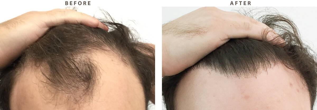 Hair Transplantation - Before and After Pictures