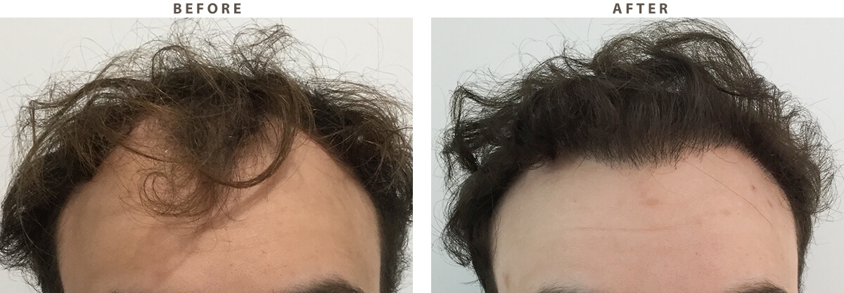 Hair Transplantation - Before and After Pictures