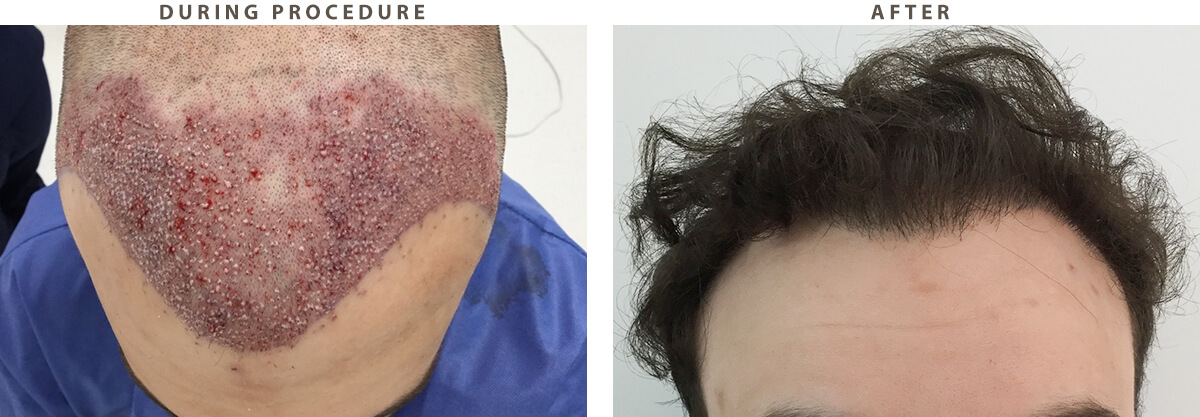 Hair Transplantation - Before and After Pictures