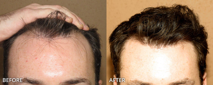 FUE Hair Transplantation – Before and After Pictures