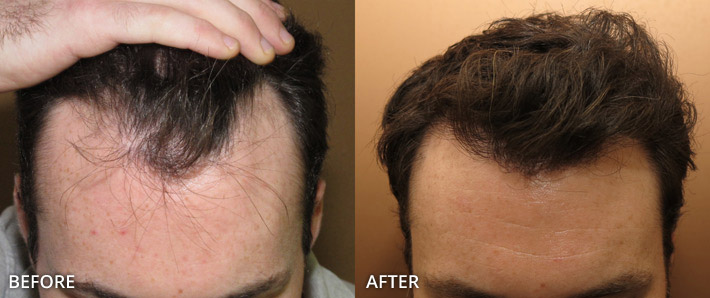 FUE Hair Transplantation – Before and After Pictures