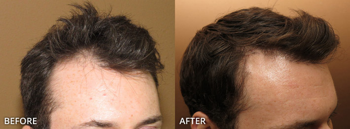 FUE Hair Transplantation – Before and After Pictures