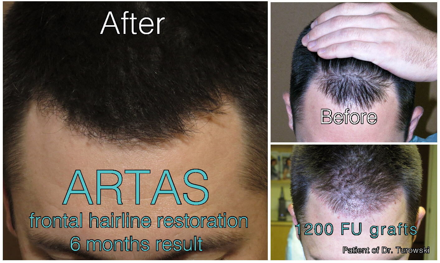 FUE Hair Transplantation – Before and After Pictures