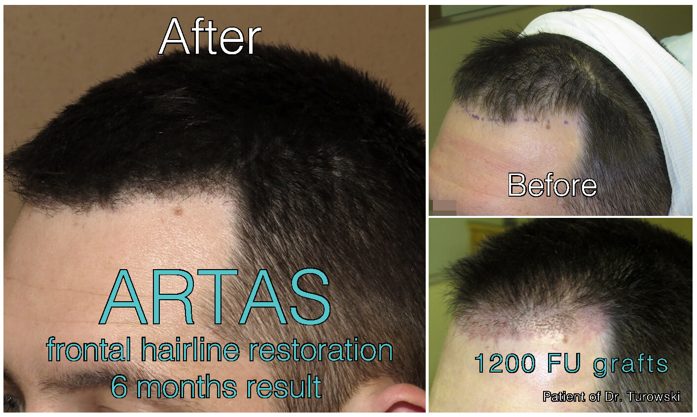 FUE Hair Transplantation – Before and After Pictures