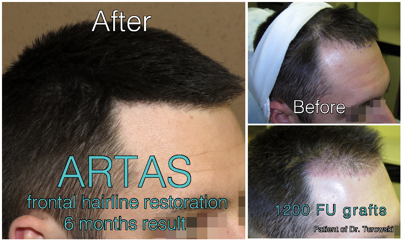 FUE Hair Transplantation – Before and After Pictures