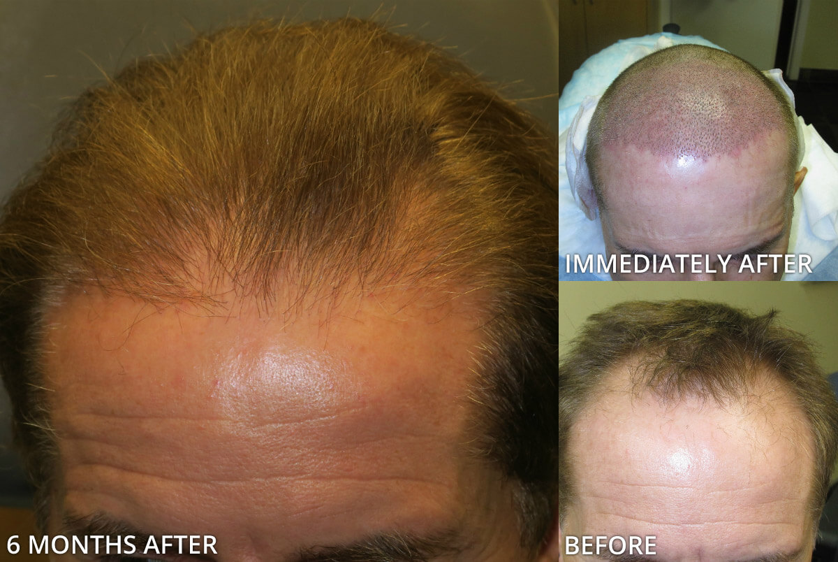 FUE Hair Transplantation – Before and After Pictures