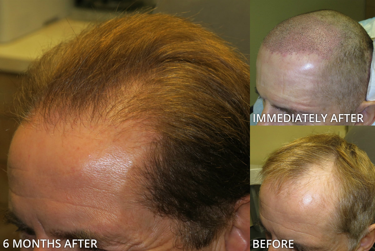 FUE Hair Transplantation – Before and After Pictures