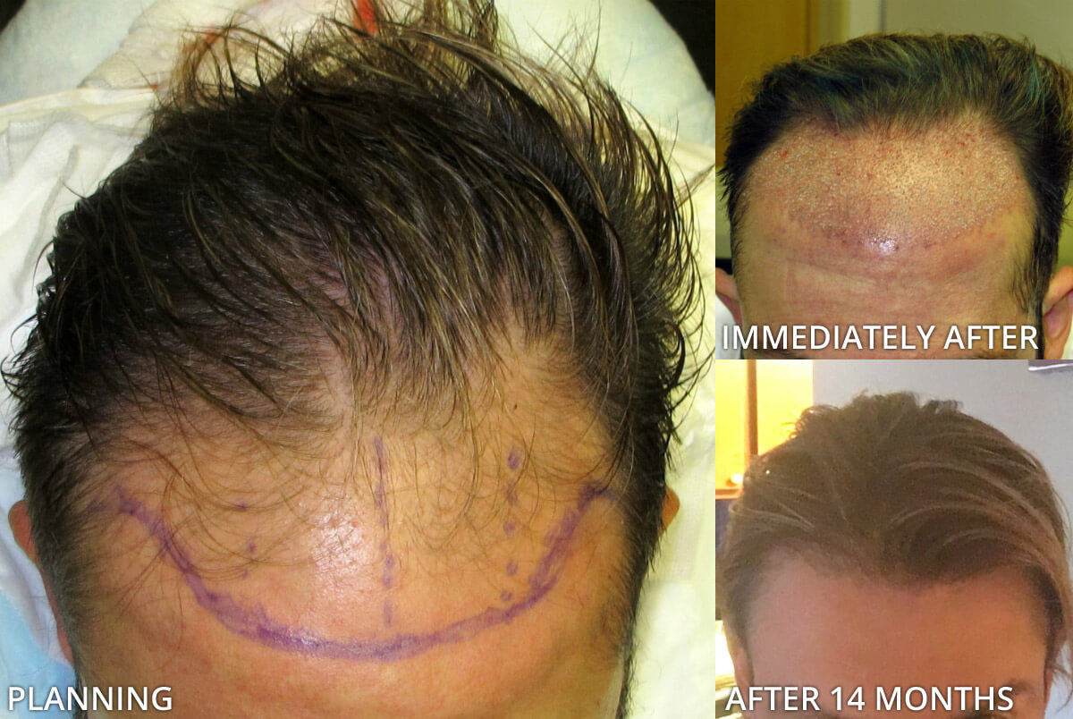 FUE Hair Transplantation – Before and After Pictures