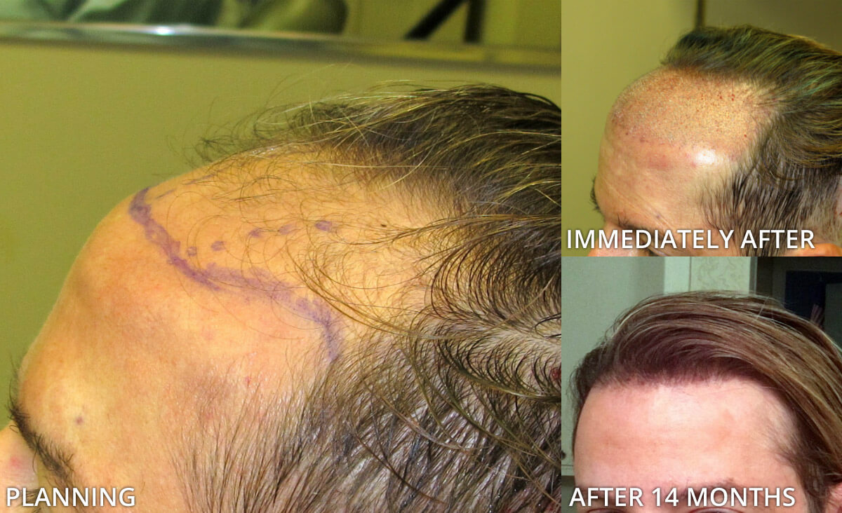 FUE Hair Transplantation – Before and After Pictures