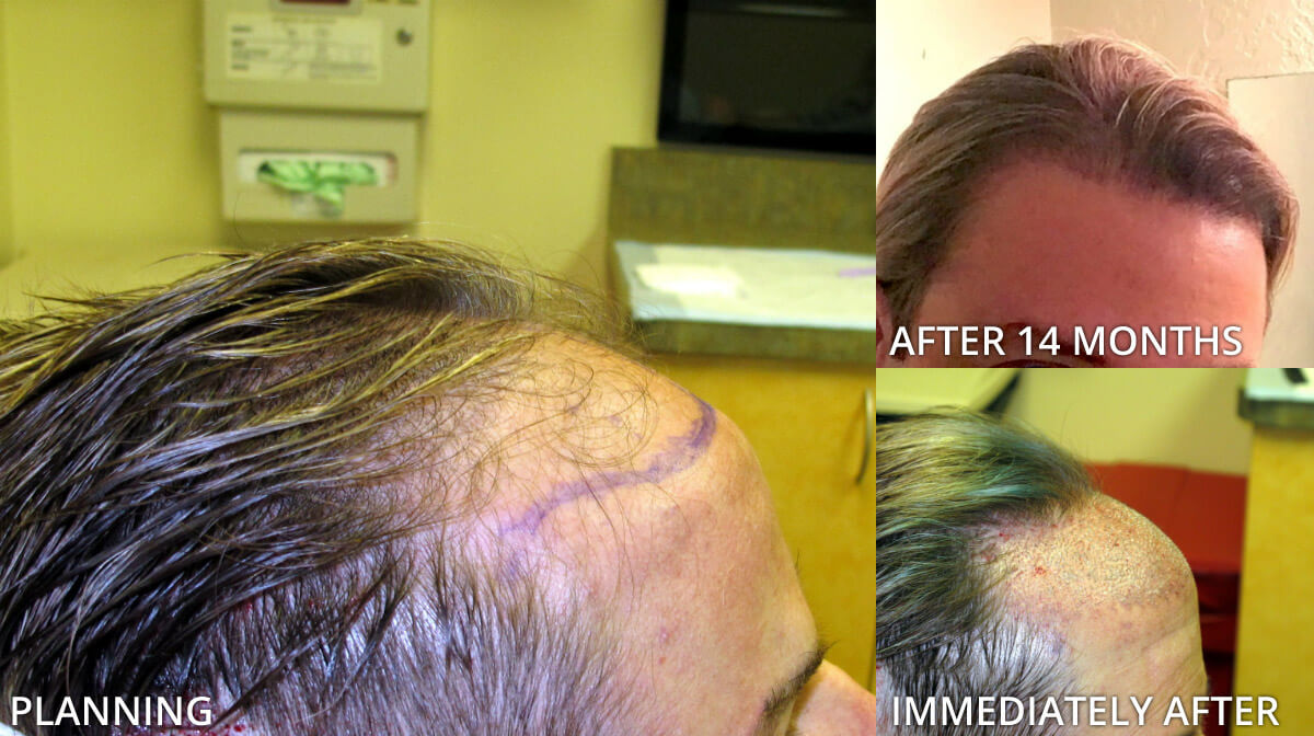 FUE Hair Transplantation – Before and After Pictures